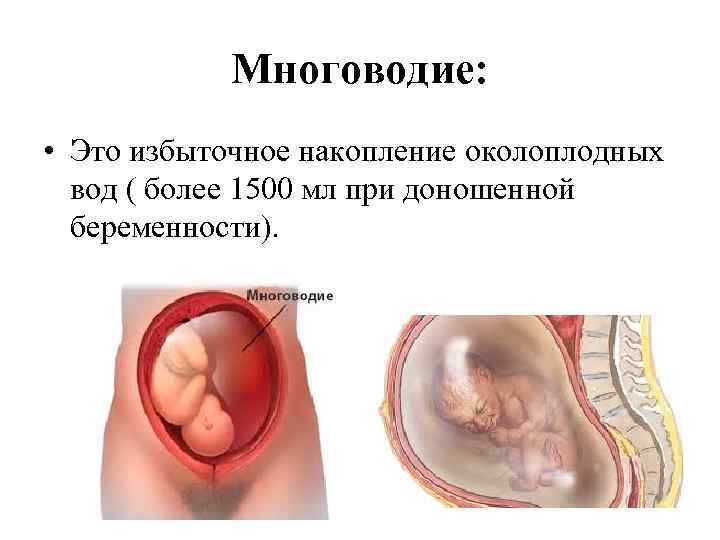 Многоводие: • Это избыточное накопление околоплодных вод ( более 1500 мл при доношенной беременности).