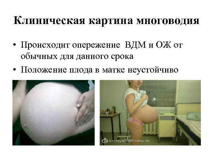 Клиническая картина многоводия • Происходит опережение ВДМ и ОЖ от обычных для данного срока