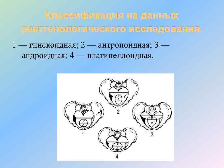 Классификация на данных рентгенологического исследования. 1 — гинекоидная; 2 — антропоидная; 3 — андроидная;