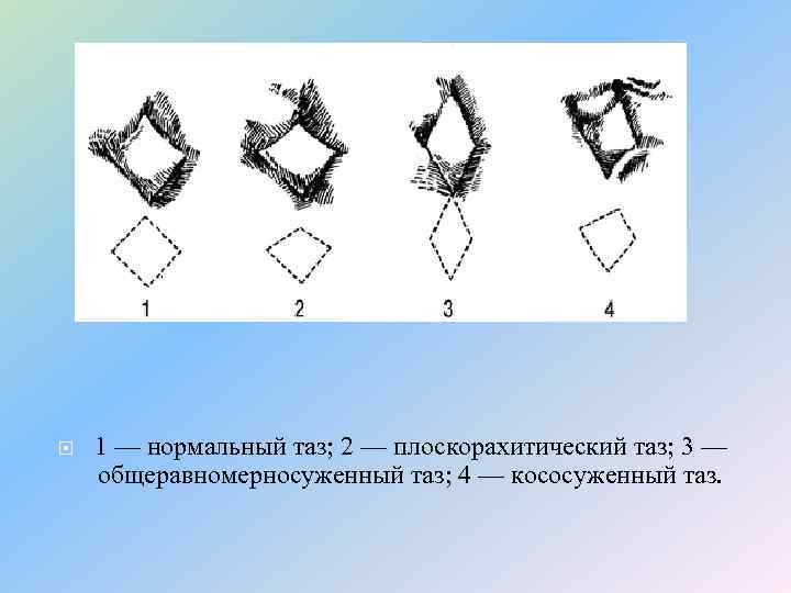  1 — нормальный таз; 2 — плоскорахитический таз; 3 — общеравномерносуженный таз; 4