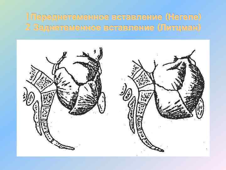 1 Переднетеменное вставление (Негеле) 2 Заднетеменное вставление (Литцман) 