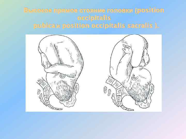 Высокое прямое стояние головки (position occipitalis pubica и position occipitalis sacralis ). 