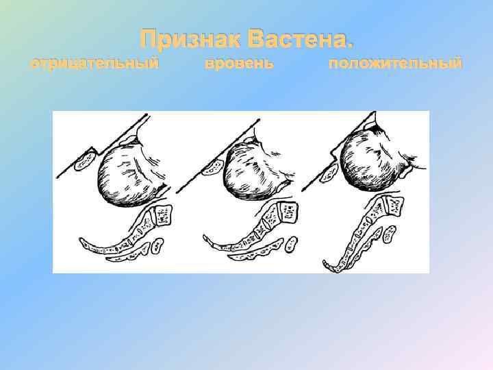 Признак Вастена. отрицательный вровень положительный 