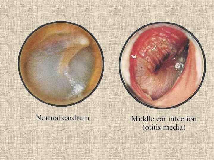 Que tomar para la otitis