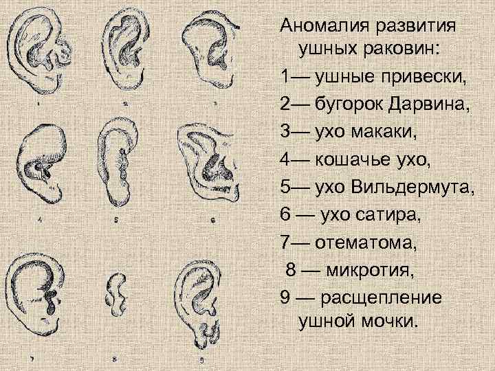 Ушные раковины образованный. Форма мочки ушной раковины. Врожденные аномалии наружного уха. Аномалии ушной раковины ухо макаки. Анатомия ушной раковины уха человека.