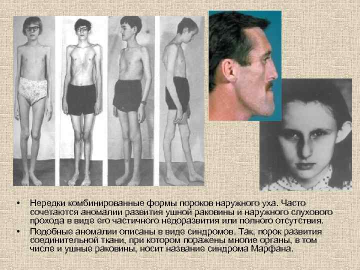  • • Нередки комбинированные формы пороков наружного уха. Часто сочетаются аномалии развития ушной