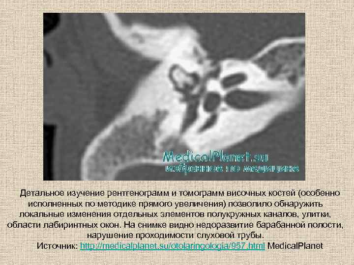 Детальное изучение рентгенограмм и томограмм височных костей (особенно исполненных по методике прямого увеличения) позволило