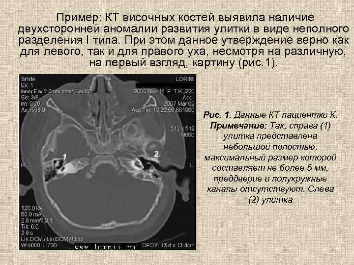  Пример: КТ височных костей выявила наличие двухсторонней аномалии развития улитки в виде неполного