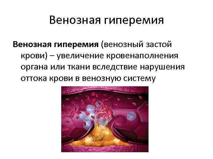 Венозная гиперемия (венозный застой крови) – увеличение кровенаполнения органа или ткани вследствие нарушения оттока