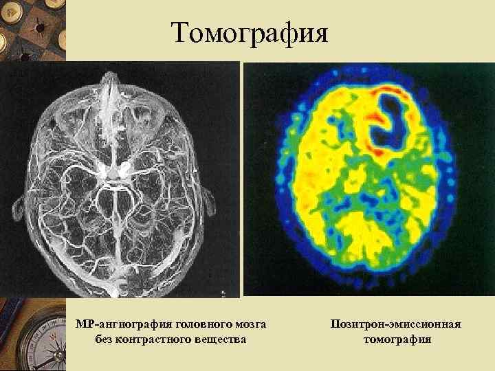 Томография МР-ангиография головного мозга без контрастного вещества Позитрон-эмиссионная томография 