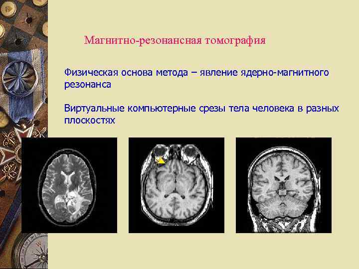 Магнитно-резонансная томография Физическая основа метода – явление ядерно-магнитного резонанса Виртуальные компьютерные срезы тела человека