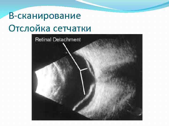 B-сканирование Отслойка сетчатки 