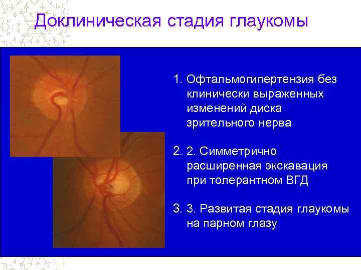 Доклиническая стадия глаукомы 1. Офтальмогипертензия без клинически выраженных изменений диска зрительного нерва 2. 2.