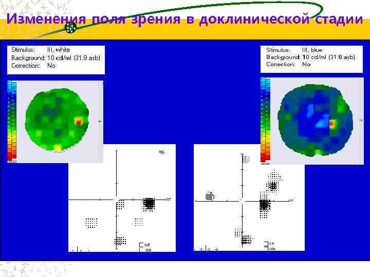 Изменения поля зрения в доклинической стадии 