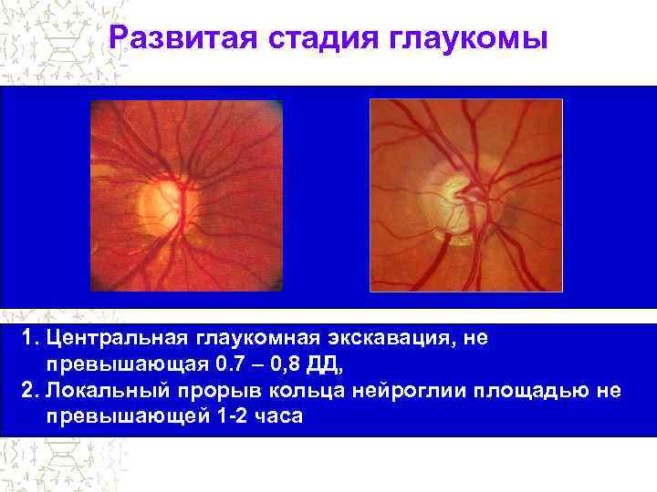 Развитая стадия глаукомы 1. Центральная глаукомная экскавация, не превышающая 0. 7 – 0, 8