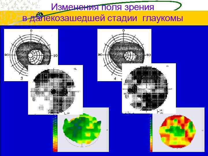 Изменения поля зрения в далекозашедшей стадии глаукомы 