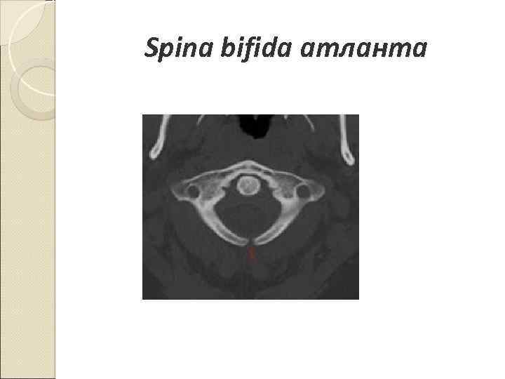 Spina bifida атланта 