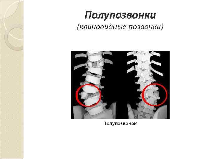 Полупозвонки (клиновидные позвонки) 