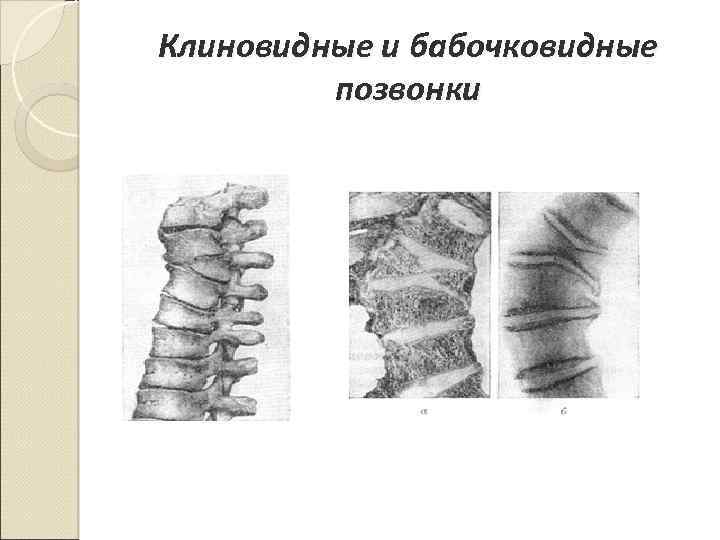 Клиновидные и бабочковидные позвонки 