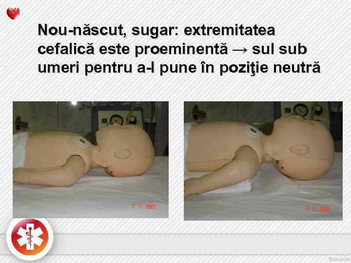 Nou-născut, sugar: extremitatea cefalică este proeminentă → sul sub umeri pentru a-l pune în