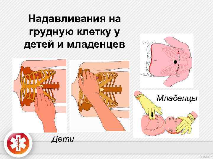 Надавливания на грудную клетку у детей и младенцев Младенцы Дети 