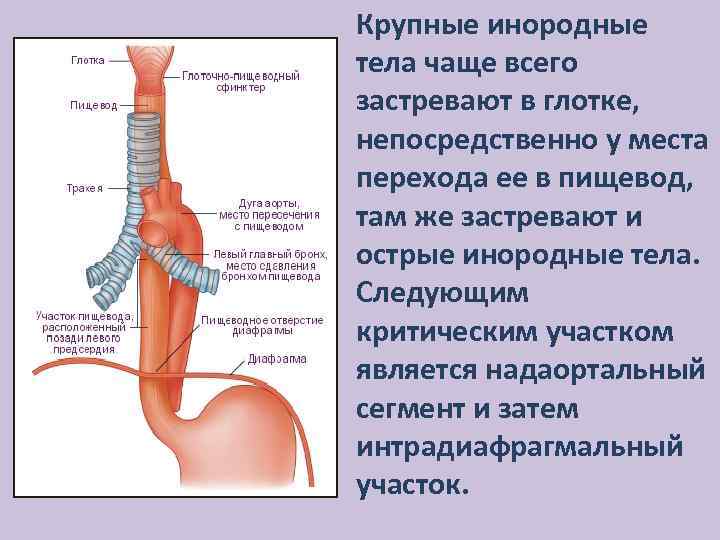 Крупные инородные тела чаще всего застревают в глотке, непосредственно у места перехода ее в