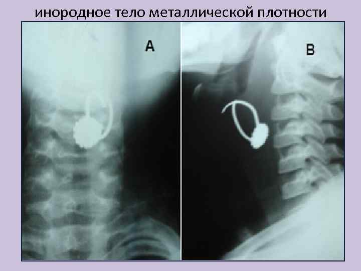 инородное тело металлической плотности 