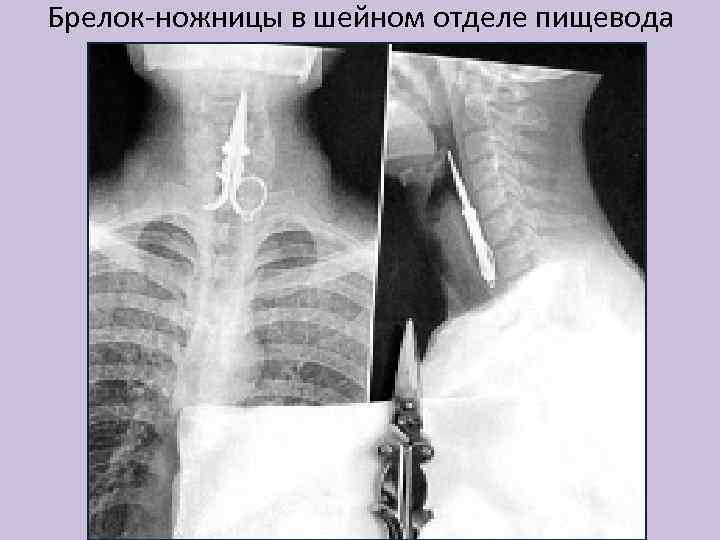 Брелок-ножницы в шейном отделе пищевода 