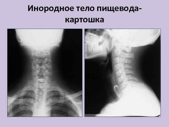 Инородные тела пищевода презентация