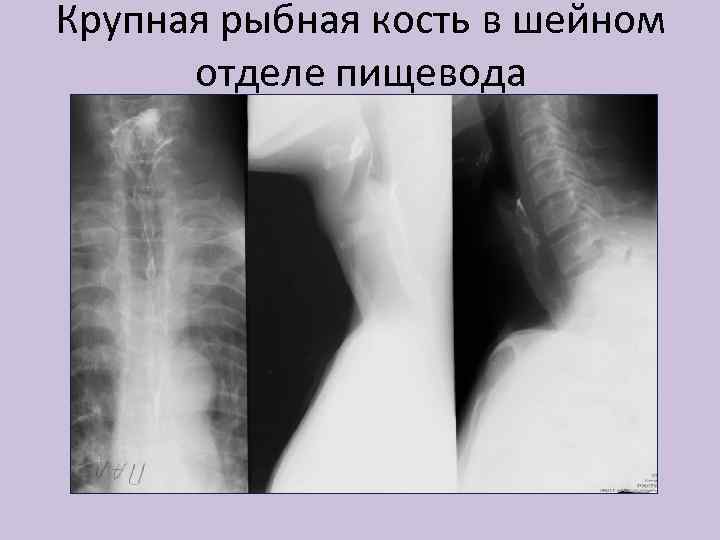 Крупная рыбная кость в шейном отделе пищевода 