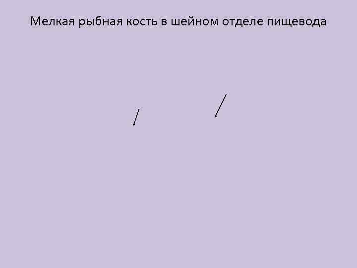 Мелкая рыбная кость в шейном отделе пищевода 