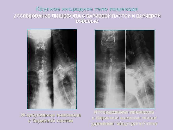 Крупное инородное тело пищевода ИССЛЕДОВАНИЕ ПИЩЕВОДА С БАРИЕВОЙ ПАСТОЙ И БАРИЕВОЙ ВЗВЕСЬЮ Исследование пищевода