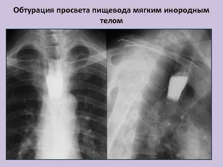 Обтурация просвета пищевода мягким инородным телом 