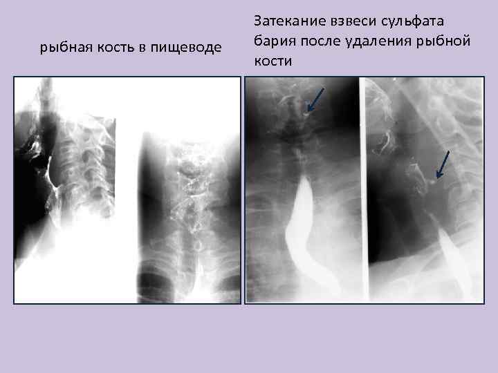 рыбная кость в пищеводе Затекание взвеси сульфата бария после удаления рыбной кости 