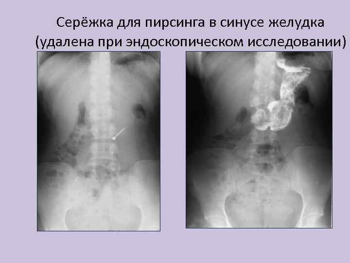 Серёжка для пирсинга в синусе желудка (удалена при эндоскопическом исследовании) 