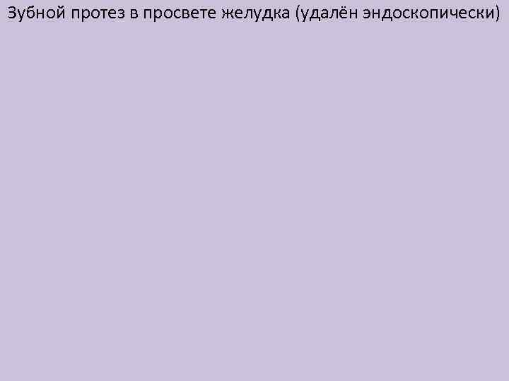 Зубной протез в просвете желудка (удалён эндоскопически) 