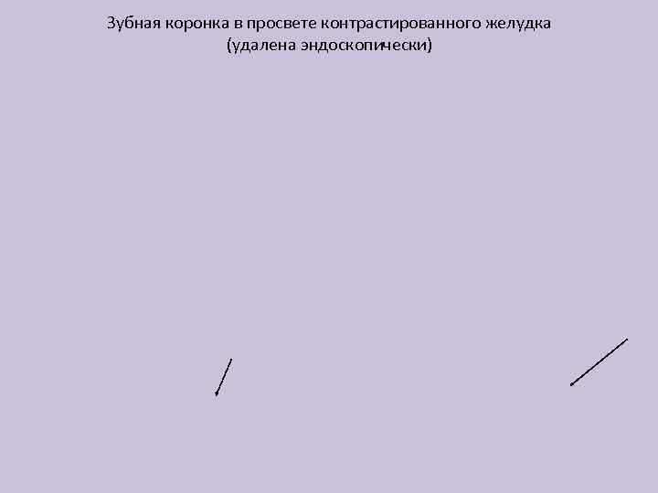 Зубная коронка в просвете контрастированного желудка (удалена эндоскопически) 