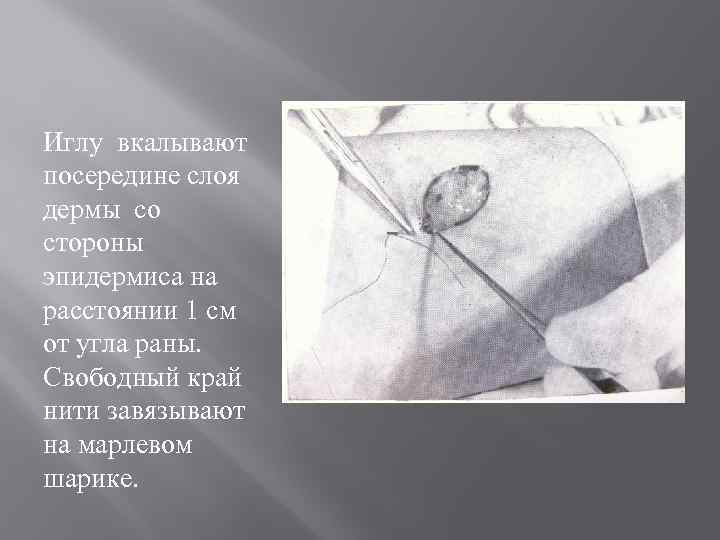 Иглу вкалывают посередине слоя дермы со стороны эпидермиса на расстоянии 1 см от угла