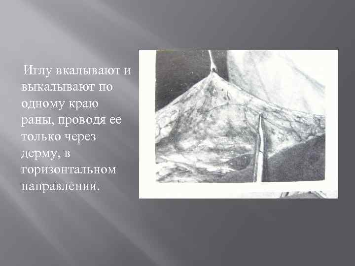 Иглу вкалывают и выкалывают по одному краю раны, проводя ее только через дерму, в