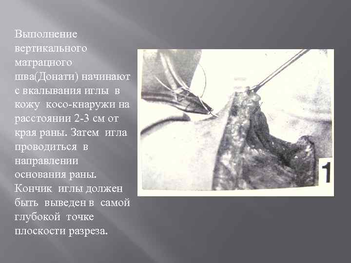 Выполнение вертикального матрацного шва(Донати) начинают с вкалывания иглы в кожу косо-кнаружи на расстоянии 2
