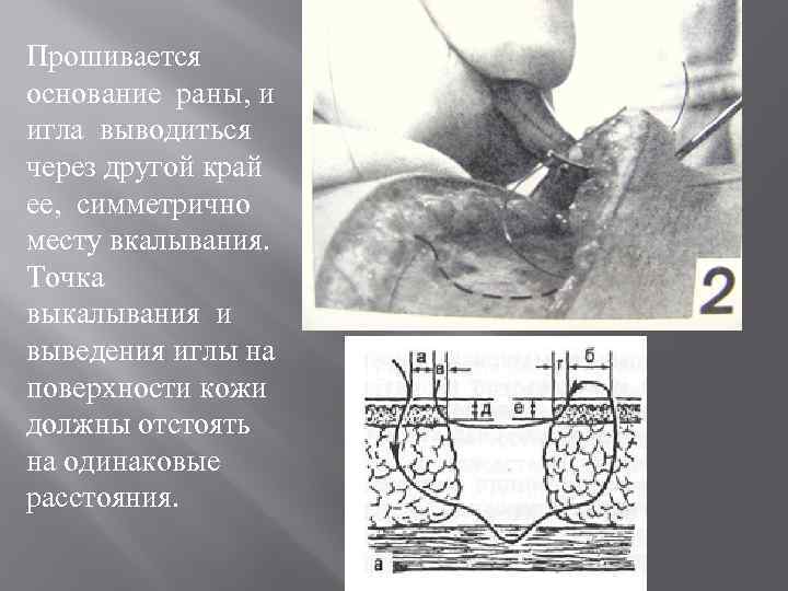 Прошивается основание раны, и игла выводиться через другой край ее, симметрично месту вкалывания. Точка