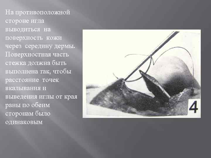 На противоположной стороне игла выводиться на поверхность кожи через середину дермы. Поверхностная часть стежка