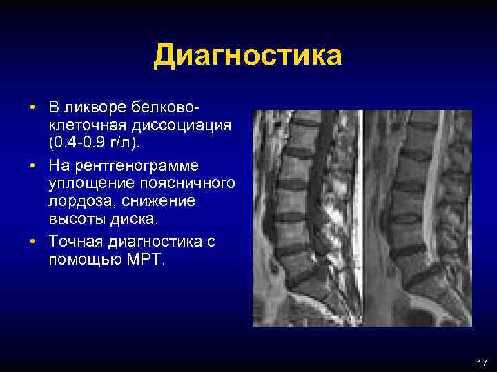 Диагностика • В ликворе белково клеточная диссоциация (0. 4 0. 9 г/л). • На