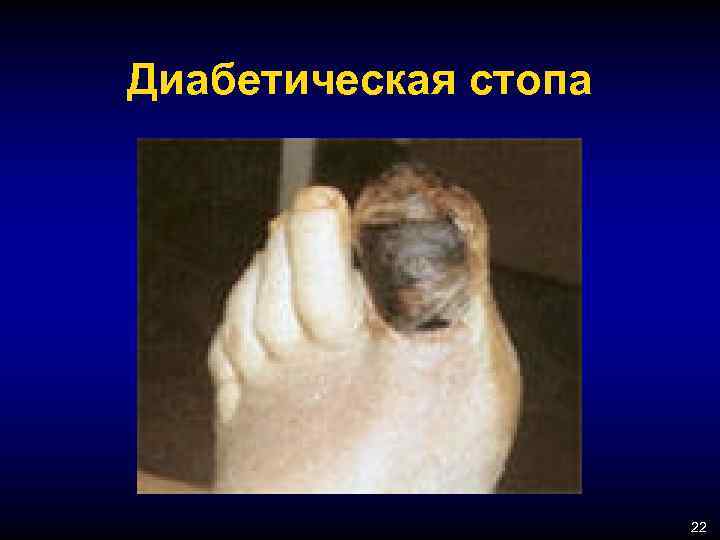 Диабетическая стопа 22 