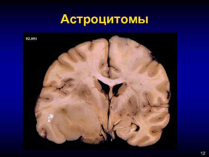 Астроцитомы 12 
