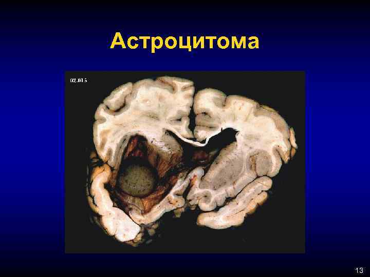 Астроцитома 13 