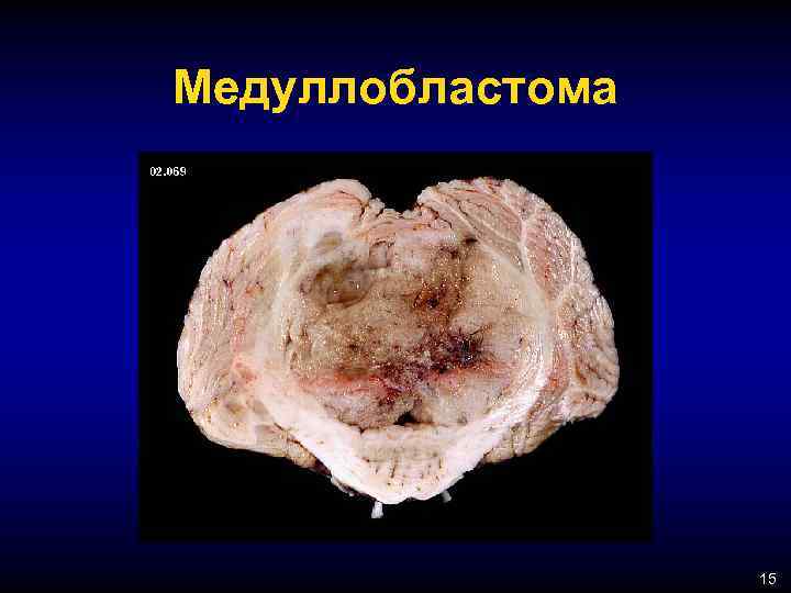 Медуллобластома 15 