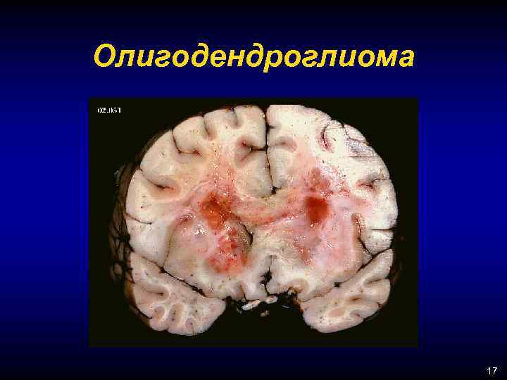 Олигодендроглиома 17 