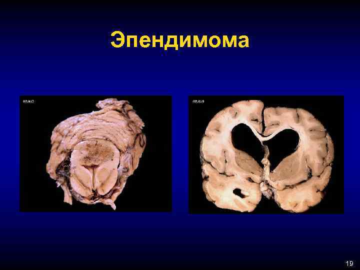 Эпендимома 19 