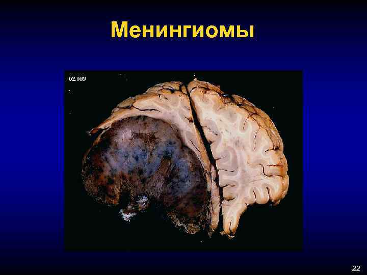 Менингиомы 22 